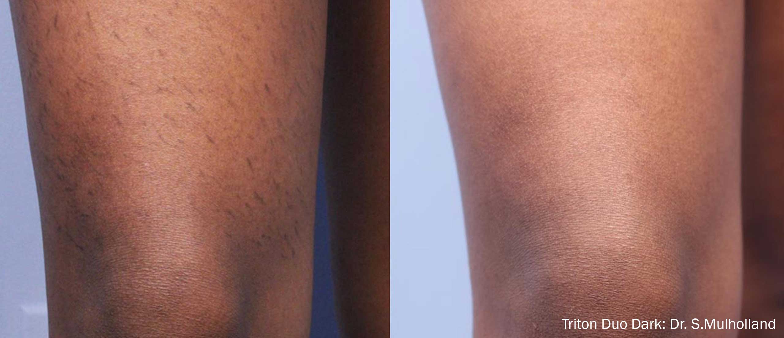 Technologie Triton d’InMode pour la réduction durable des poils